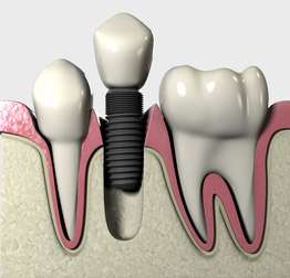 Implant 3D Diagram