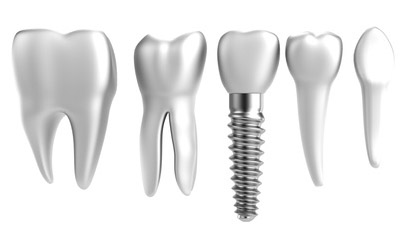 Tooth Implant Comparison