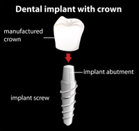 Model of a dental implant